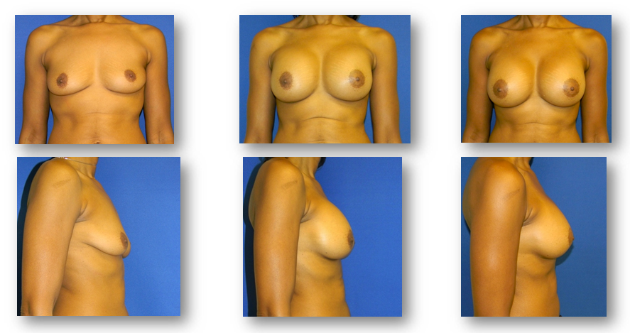 Chevy Chase Breast Augmentation