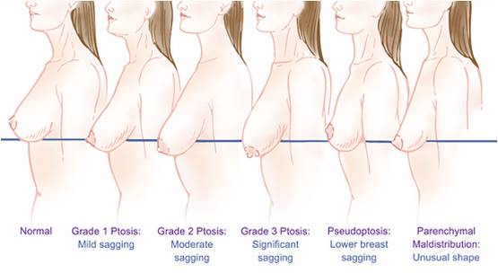 Breast lift natural