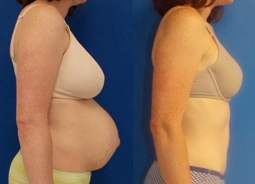 Tummy Tuck Washington DC