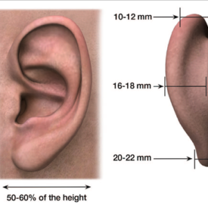 otoplasty picture