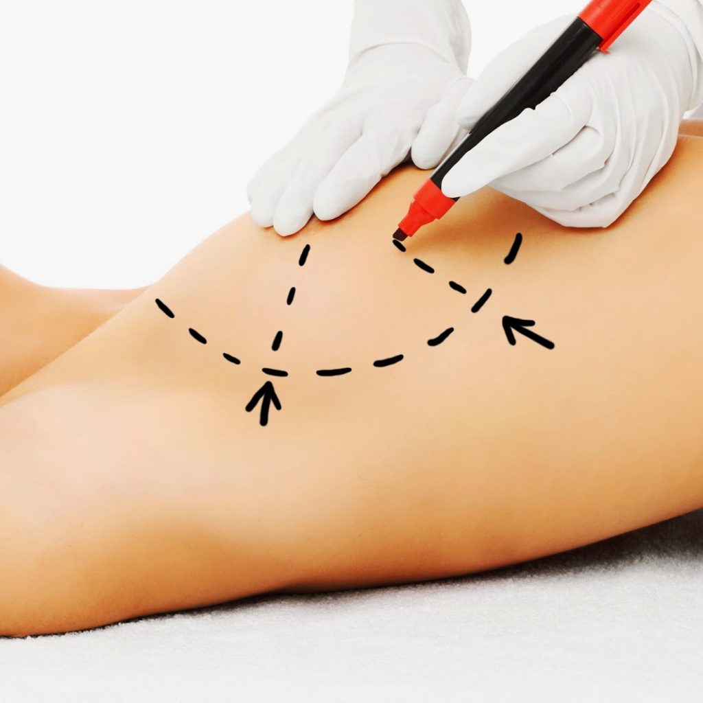 Breast Augmentation Chevy Chase