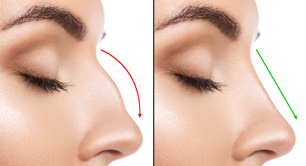 Rhinoplasty McLean VA