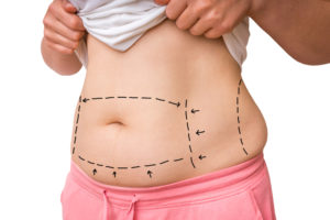 Tummy Tuck Transformation