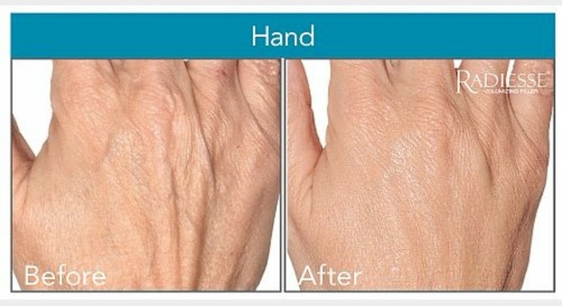 Radiesse for Hands