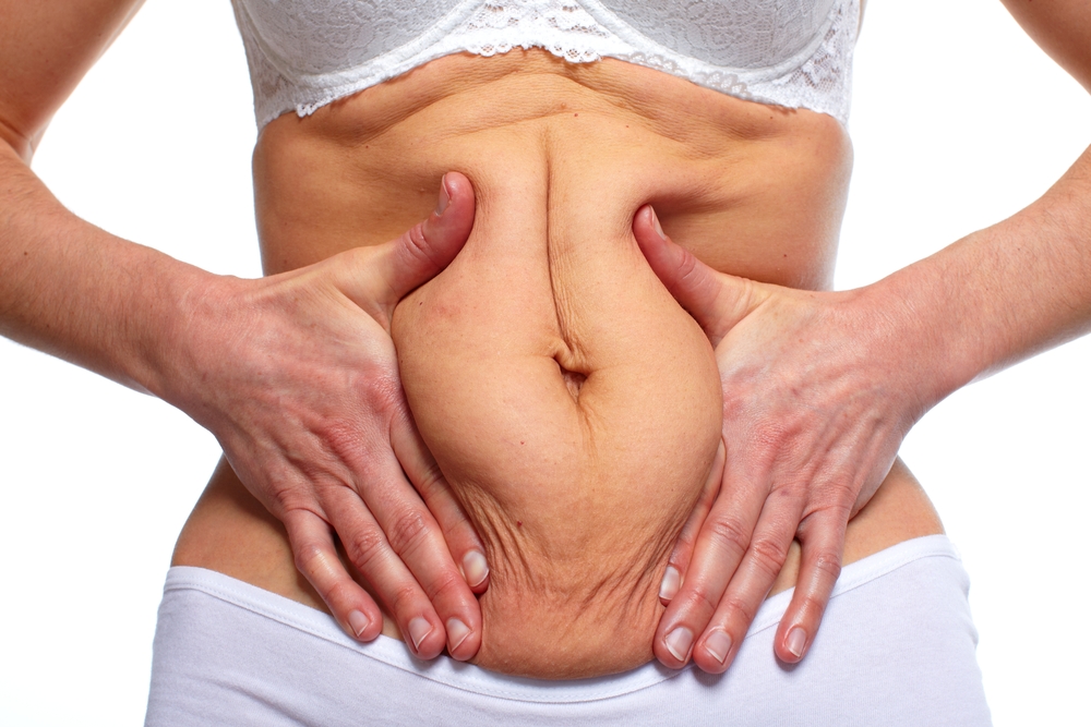 Tummy Tucks: Major Medical Benefit