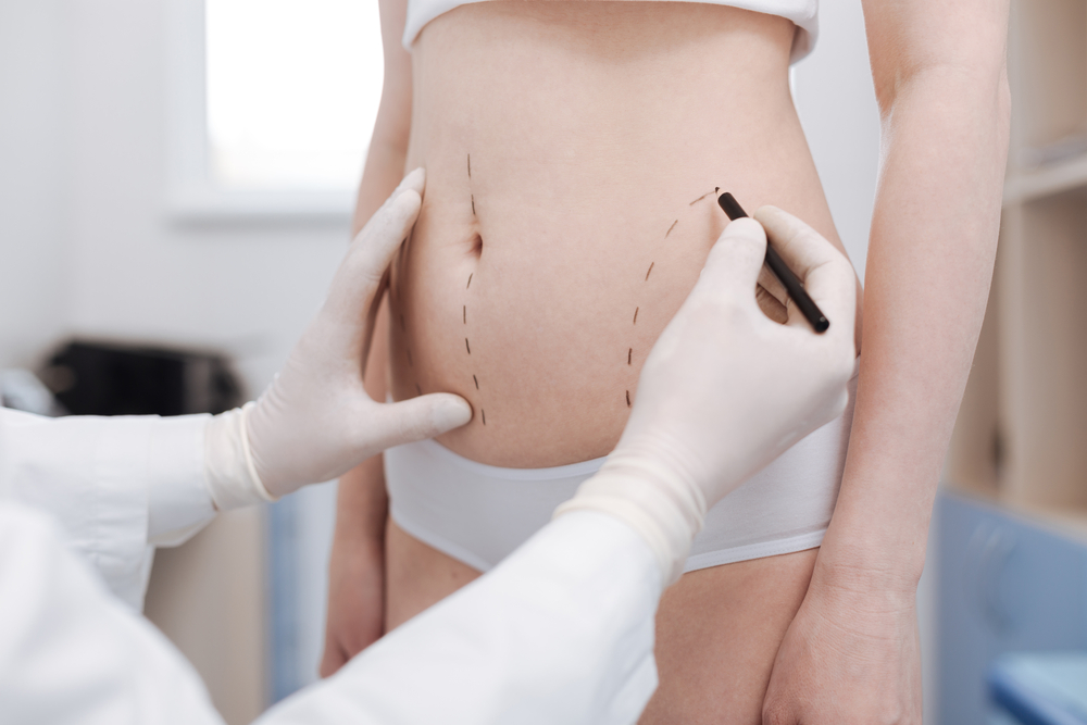 What You Need to Know About Liposuction Recovery