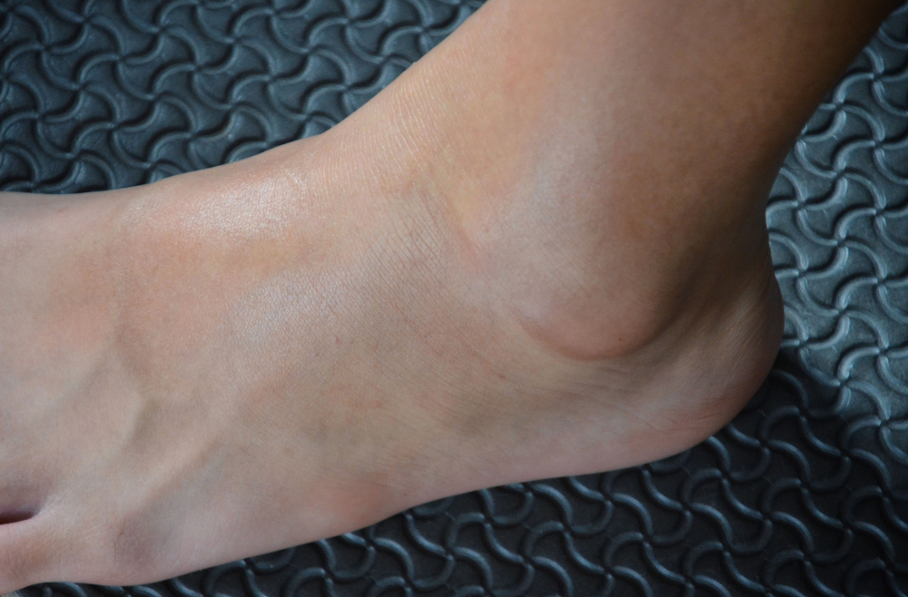 Cankles: What Are They and How to Get Rid of Them