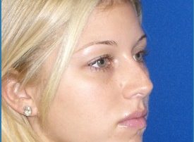 NOSE SURGERY – RHINOPLASTY