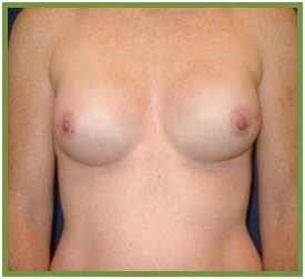 BREAST CANCER RECONSTRUCTION