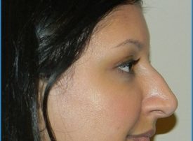 NOSE SURGERY – RHINOPLASTY