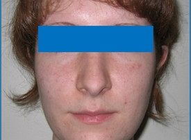 NOSE SURGERY – RHINOPLASTY