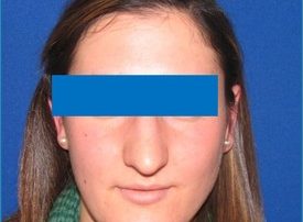 NOSE SURGERY – RHINOPLASTY