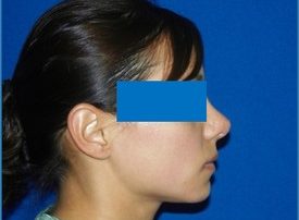 NOSE SURGERY – RHINOPLASTY