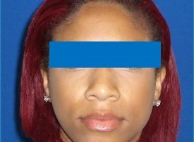 NOSE SURGERY – RHINOPLASTY