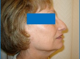 NOSE SURGERY – RHINOPLASTY