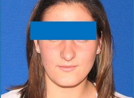 NOSE SURGERY – RHINOPLASTY