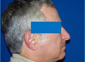 NOSE SURGERY – RHINOPLASTY