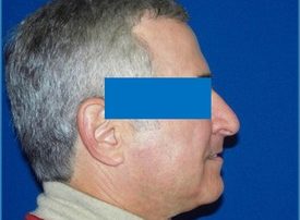NOSE SURGERY – RHINOPLASTY