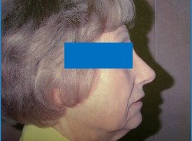 NOSE SURGERY – RHINOPLASTY