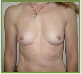 BREAST CANCER RECONSTRUCTION