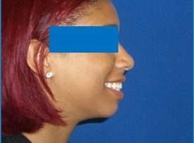 NOSE SURGERY – RHINOPLASTY
