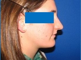 NOSE SURGERY – RHINOPLASTY