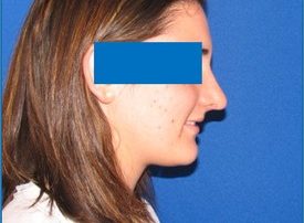 NOSE SURGERY – RHINOPLASTY