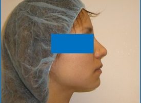 NOSE SURGERY – RHINOPLASTY