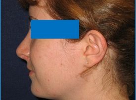 NOSE SURGERY – RHINOPLASTY