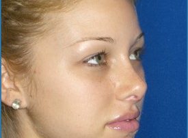 NOSE SURGERY – RHINOPLASTY