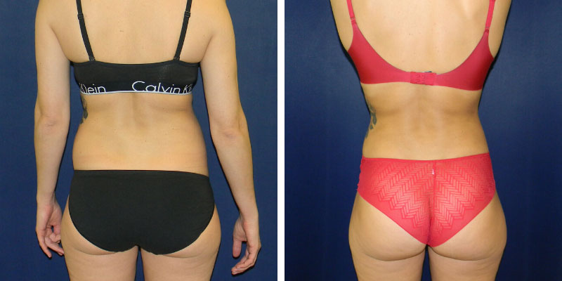 Smartlipo of the Back - Flanks, Bra Rolls, and Neck Humps - Explore Plastic  Surgery