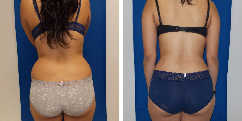 Smartlipo Flanks Liposuction for Women - Before & After Photos