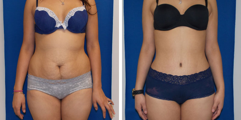 Smartlipo of the Back - Flanks, Bra Rolls, and Neck Humps - Explore Plastic  Surgery