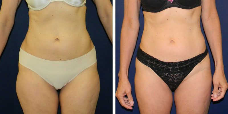 Los Angeles Liposuction Centers on X: Female patient is one year post op  from Smartlipo of her upper back and bra fat. Her results? A leaner,  curvier and more defined back. Who