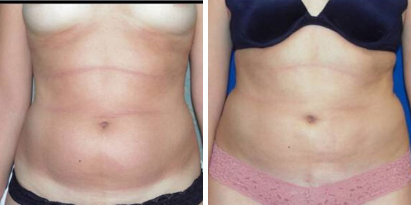 LIPOSUCTION/LASER LIPO/SMART LIPO