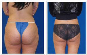 Laser Lipo