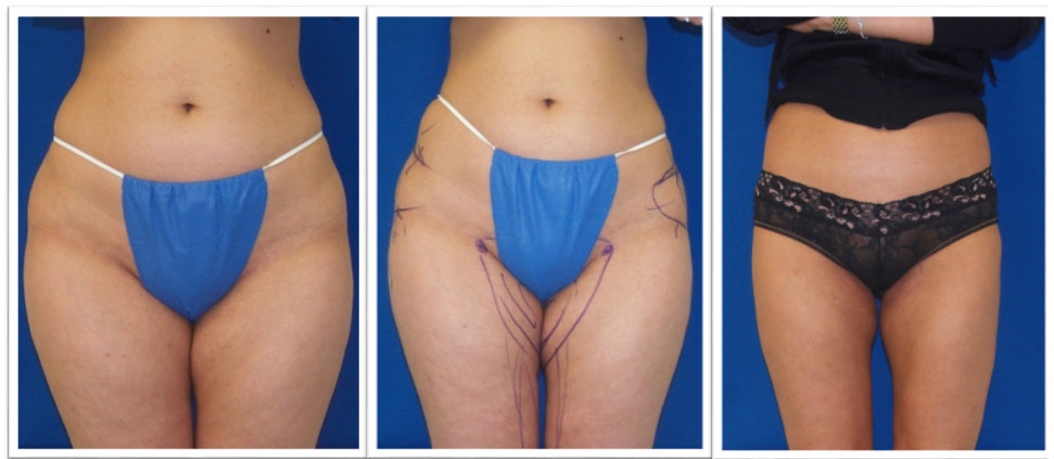 Laser Lipo