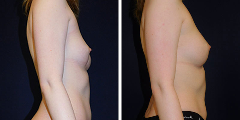 Breast Fat Grafting  Northern Virginia, Washington DC, McLean