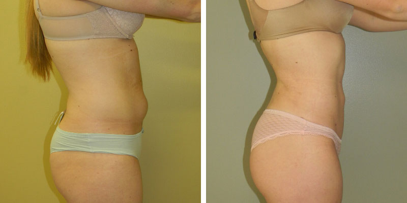 LIPOSUCTION/LASER LIPO/SMART LIPO