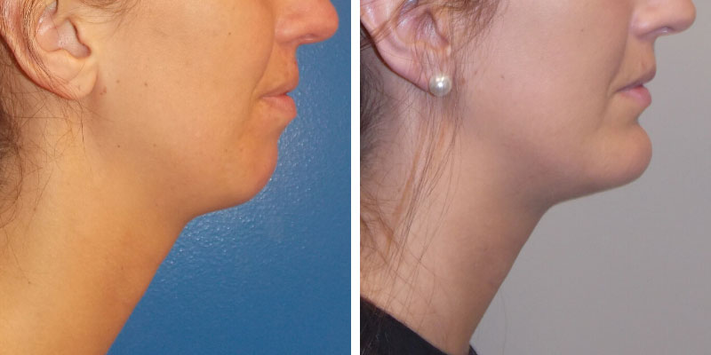 CHIN AND CHEEK IMPLANT