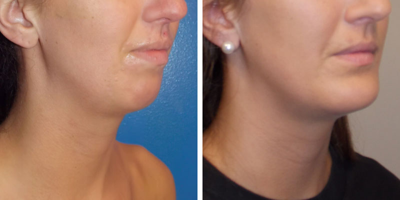 CHIN AND CHEEK IMPLANT0