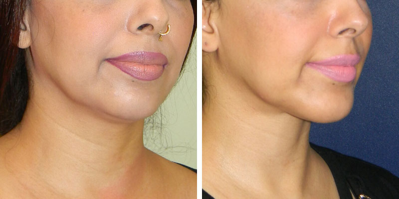 CHIN AND CHEEK IMPLANT