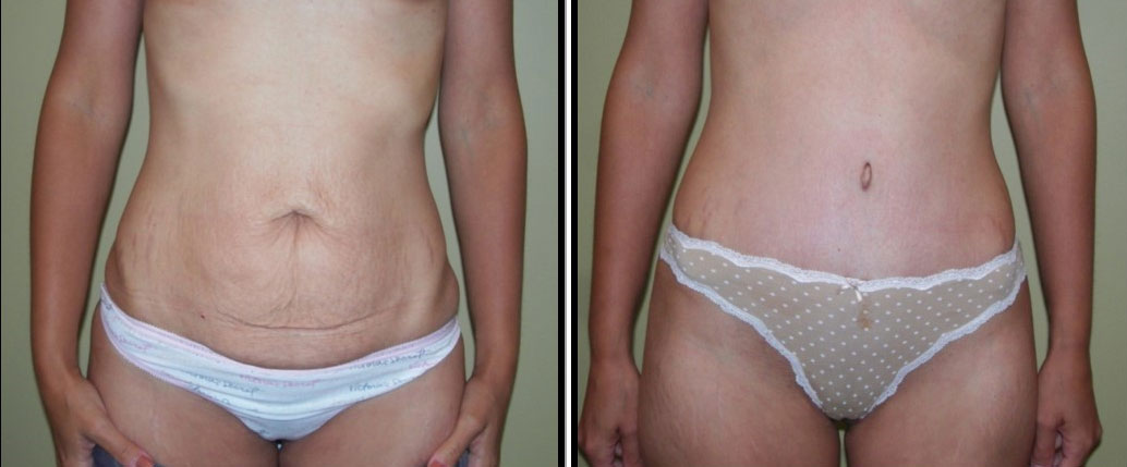 Tummy tuck