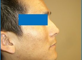 NOSE SURGERY – RHINOPLASTY