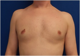 MALE ENLARGED BREAST REDUCTION – GYNECOMASTIA
