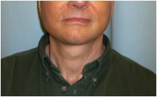 MALE CHIN AND CHEEK IMPLANT