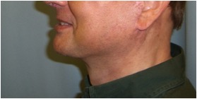 MALE CHIN AND CHEEK IMPLANT