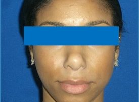 NOSE SURGERY – RHINOPLASTY