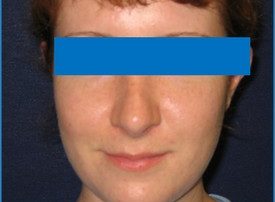 NOSE SURGERY – RHINOPLASTY