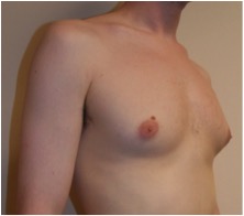 MALE ENLARGED BREAST REDUCTION – GYNECOMASTIA